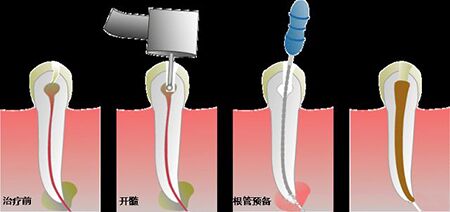 牙齿根管治疗疼不疼