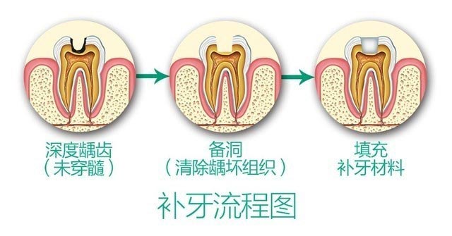 补牙的流程